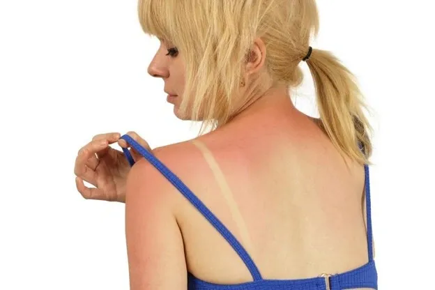 Treating A Sunburn